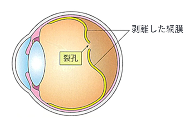 網膜剥離手術 | 下田眼科
